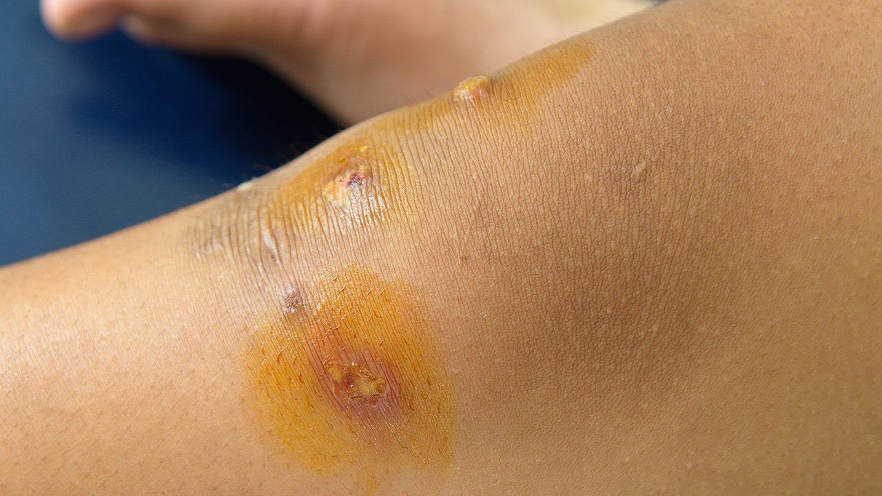 Γαγγραινώδες πυόδερμα: καρδιαγγειακός παράγοντας κινδύνου