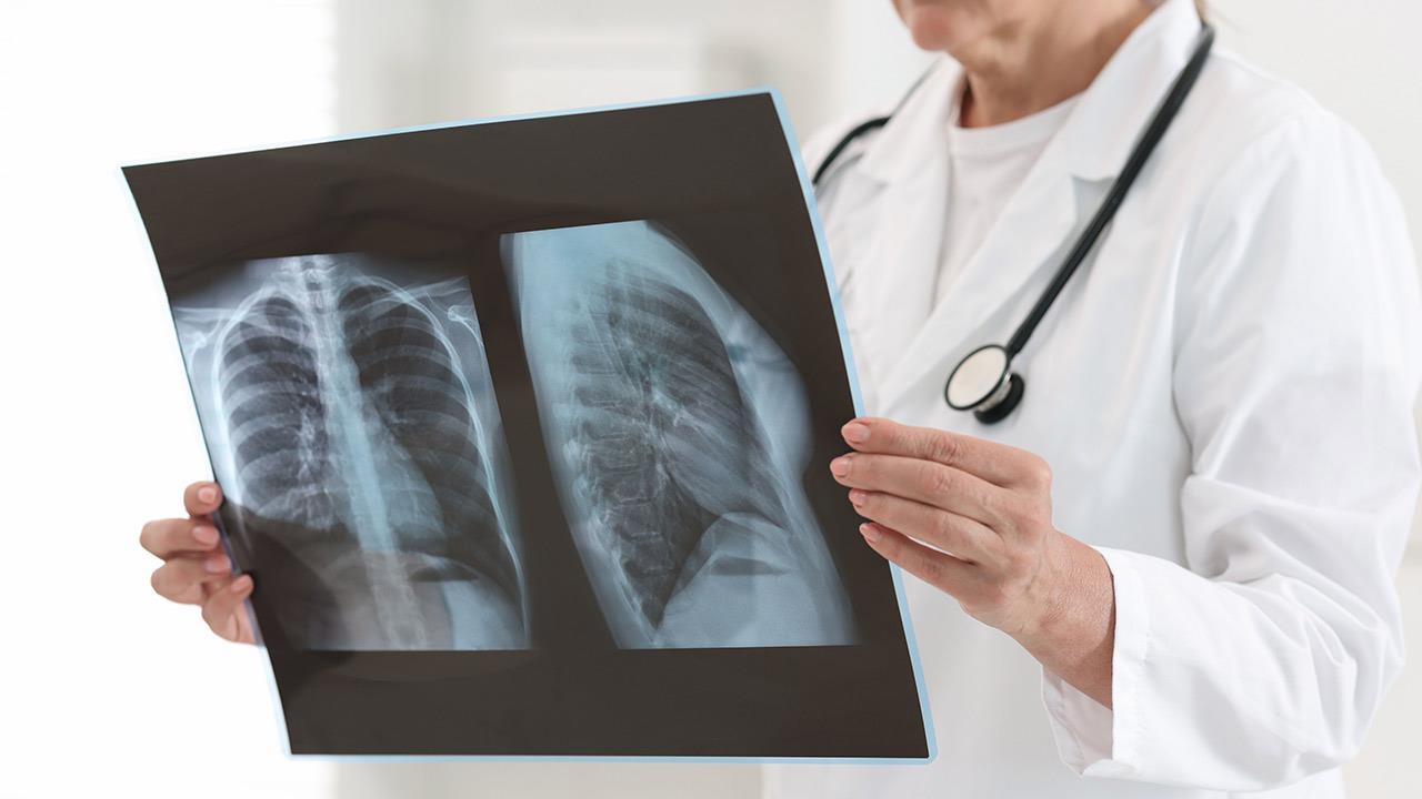 Φυματίωση: ίδιες πιθανότητες νόσησης ανδρών και γυναικών μετά την επιμόλυνση