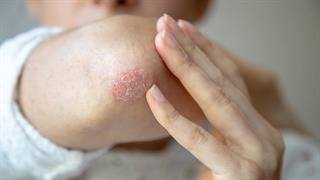 Παγκόσμια Ημέρα Ψωρίασης η 29η Οκτωβρίου 2025- Η νόσος δεν σταματά στο δέρμα