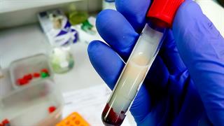 Τα λιπίδια βασικοί παράγοντες των καρδιαγγειακών παθήσεων