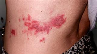 Αιμαγγειώματα στα παιδιά: Τι πρέπει να ξέρουν οι γονείς