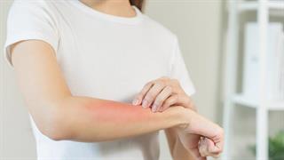 Ατοπική δερματίτιδα: Ανακαλύφθηκε ο μηχανισμός του κνησμού