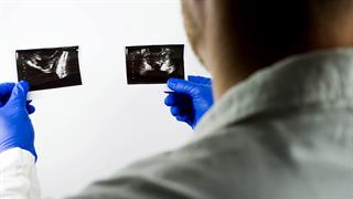 Καρκίνος του προστάτη: Νέο μοντέλο πρόβλεψης κινδύνου θανάτου μετά από PSA