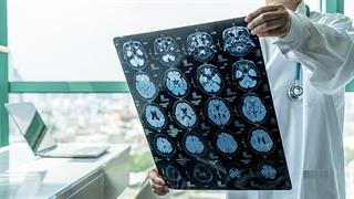 Long COVID: Μπορεί να συνδέεται με μηχανισμούς που σχετίζονται με τη νόσο Alzheimer