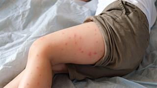 Μείωση κρουσμάτων ιλαράς στην Ευρώπη - Ανησυχία, όμως, από τον ΠΟΥ