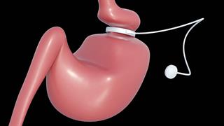 Γαστρικός δακτύλιος: Γιατί πρέπει να αφαιρείται