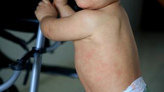 ΕΟΔΥ: Μπαίνουμε σε περίοδο έξαρσης της ιλαράς - 1 στους 3 εμφανίζει επιπλοκές