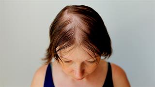 Μπορεί το στρες να προκαλέσει τριχόπτωση;