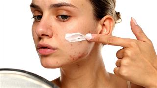 Ακμή προσώπου και μαύρα στίγματα: Τα βήματα για ορατή βελτίωση