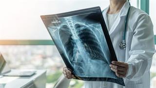 ΕΜΑ: Νέα θεραπεία για υποτροπιάζοντα μικροκυτταρικό καρκίνο του πνεύμονα