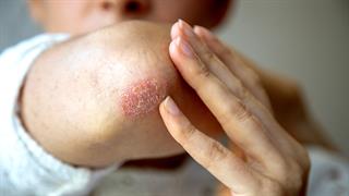 Ψωρίαση: Μύθοι και αλήθειες