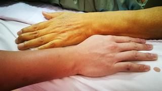 Κίτρινο χρώμα δέρματος: Πού μπορεί να οφείλεται