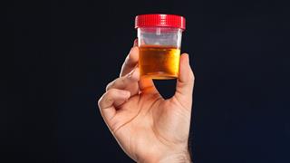 Νέο, γρήγορο τεστ ούρων για την ουρολοίμωξη [μελέτη]