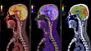 Η Πυρηνική Ιατρική στην Ογκολογία: Νέα ραδιοφάρμακα για διάγνωση και θεραπεία