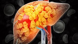 Ηπατική ίνωση: Αθέατη απειλή για τη Δημόσια Υγεία