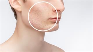 Τι προκαλεί ακμή γύρω από το στόμα;