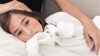 Ιλαρά: Χωρίς κρούσμα από τον περασμένο Ιούνιο η Ελλάδα - Τι γίνεται με την ερυθρά