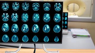 Γλοιοβλάστωμα: Η σημασία των εγκεφαλικών δικτύων στην πρόγνωση του