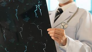 Παροδικό ισχαιμικό επεισόδιο: Αυξημένος κίνδυνος άνοιας ακόμη και δεκαετίες αργότερα